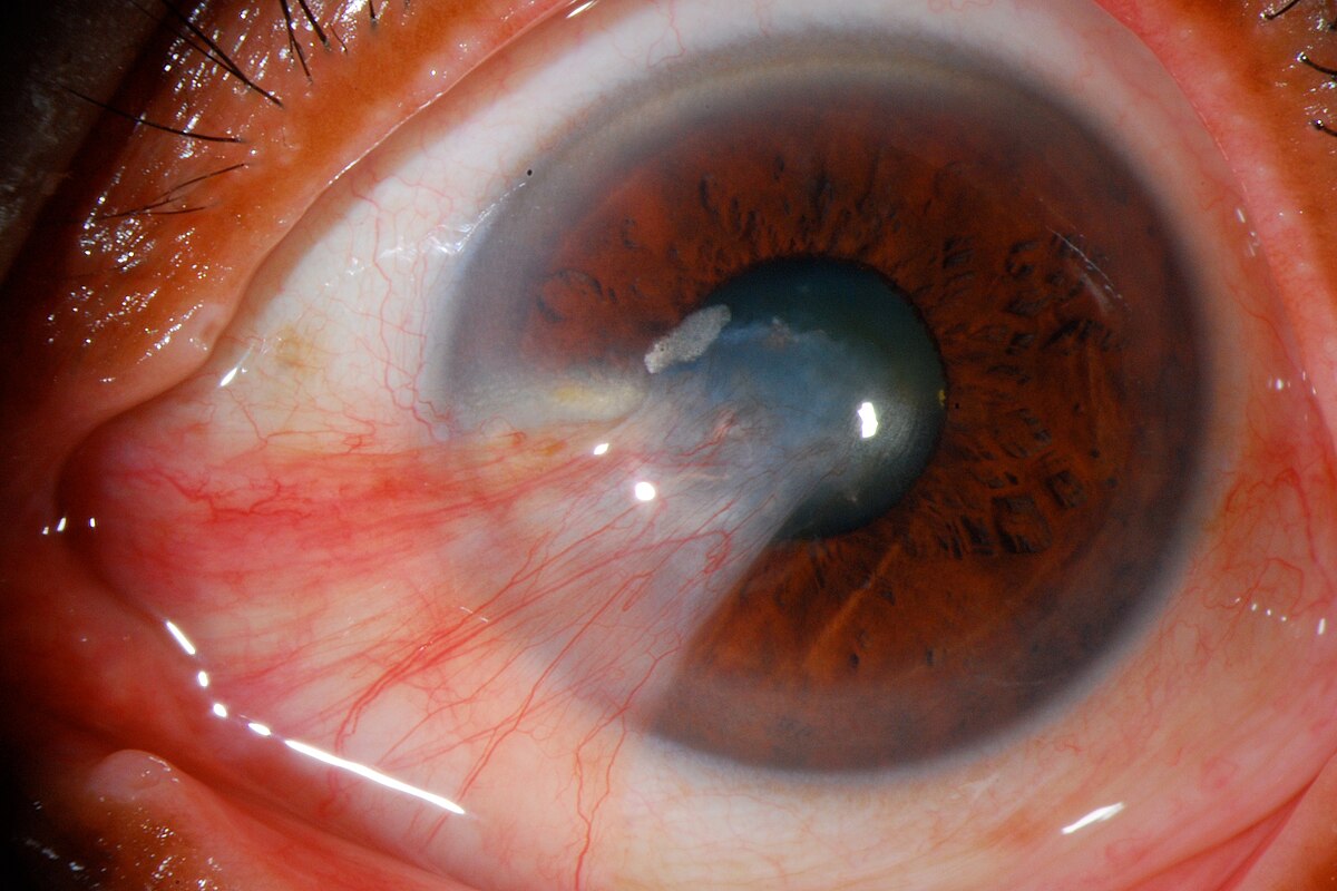 Cornea