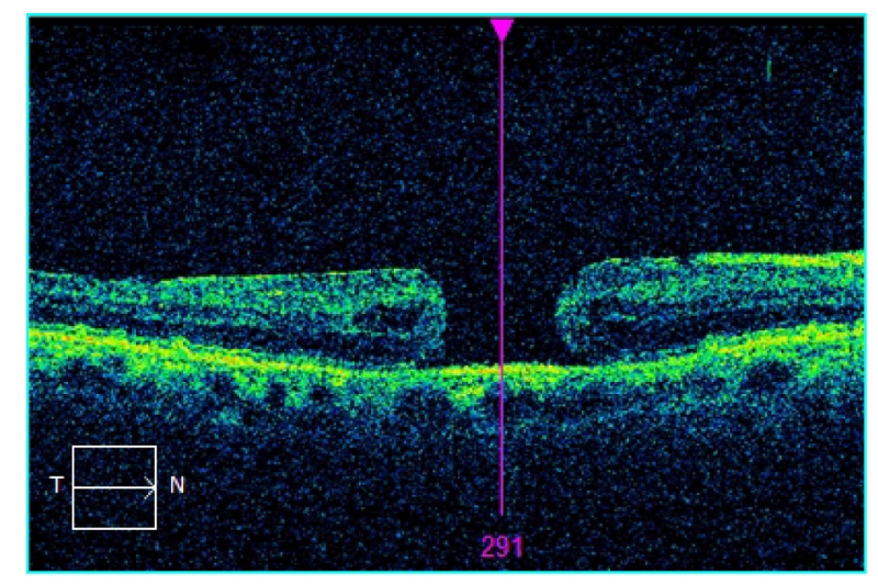 Macular Hole Result