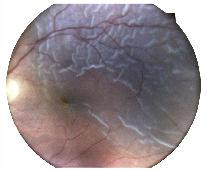 Retinal Detachment Result