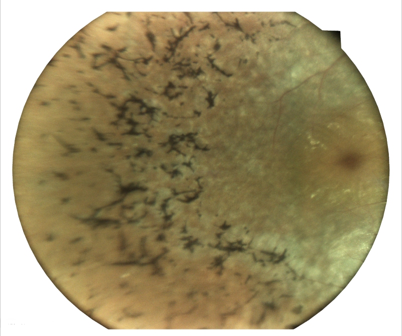 Retinitis Pigmentosa Result