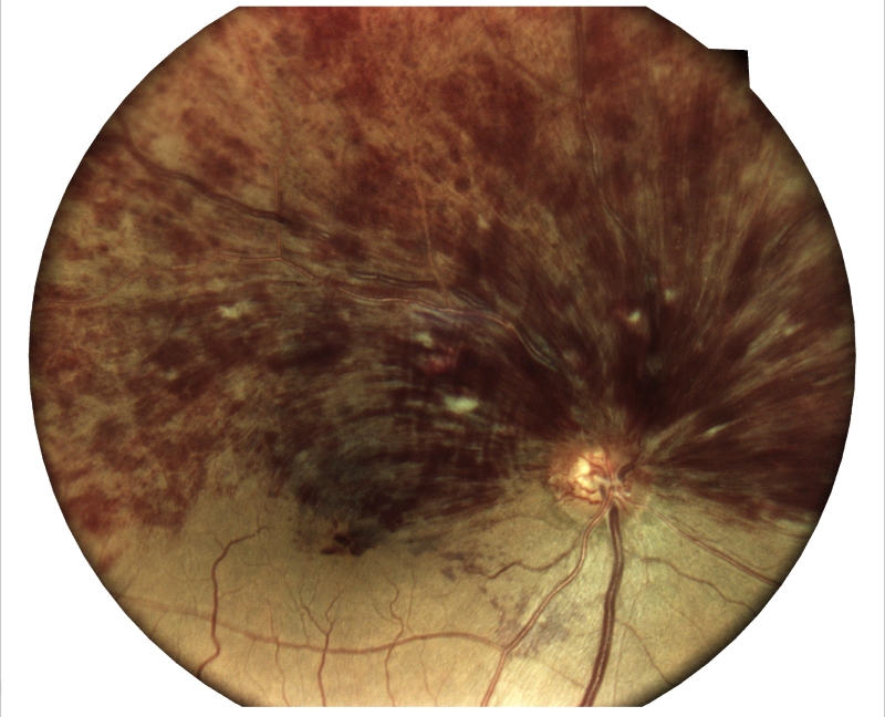 Retinal Vein Occlusion Result